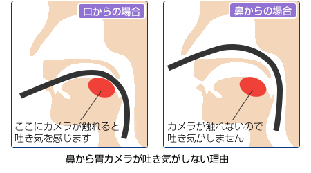 鼻からの胃カメラは、嘔吐反射する部分を触らないので口からに比べ楽な検査になります。